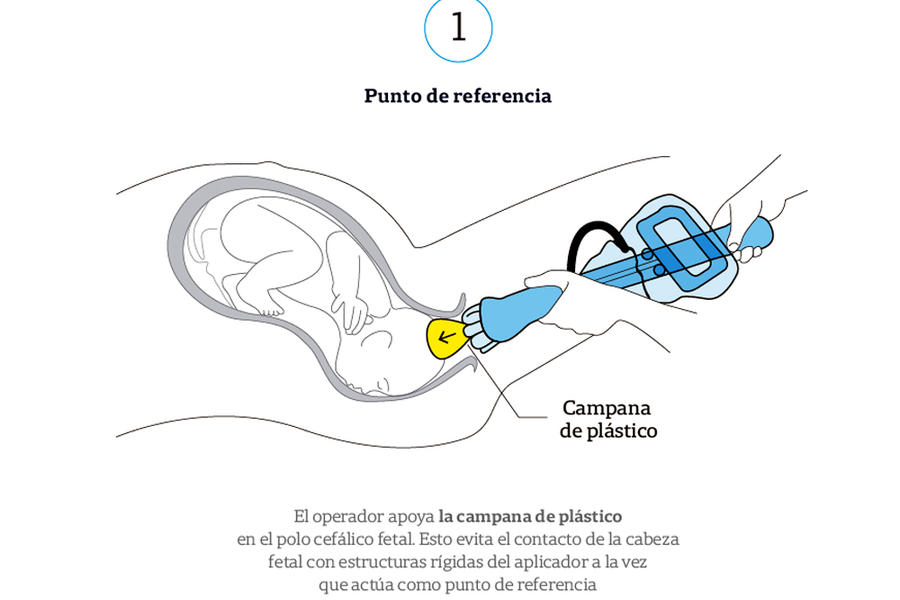 Esquema de uso del dispositivo Odón ► 1 (Fuente: CEMIC / La Nación)  