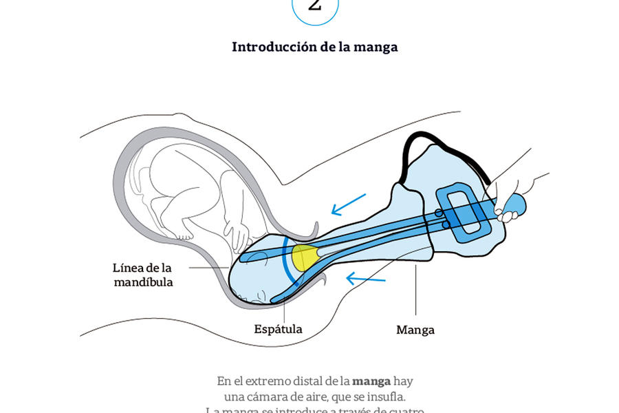 Esquema de uso del dispositivo Odón ► 2 (Fuente: CEMIC / La Nación)  