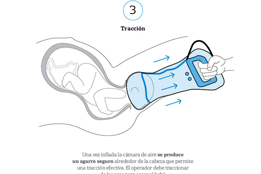 Esquema de uso del dispositivo Odón ► 3 (Fuente: CEMIC / La Nación)  
